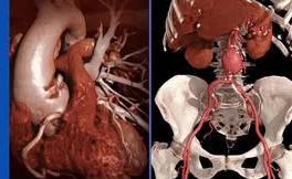 Reconstrucción 3D de angiotomografía